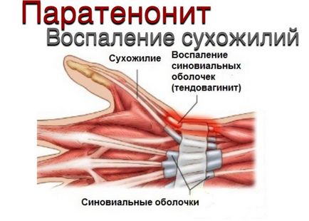 Paratenonita, inflamația tendoanelor