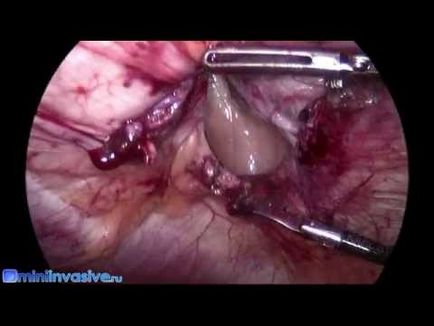 Inghinală, postoperatorie și alte hernie abdominale