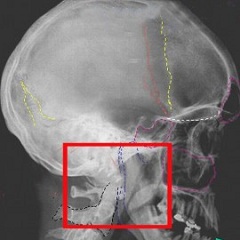 Fractura bazei craniului - simptome, tratament, consecințe