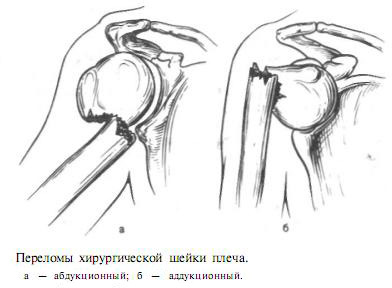 Fractura de tratament cu humerus, simptome și prim ajutor