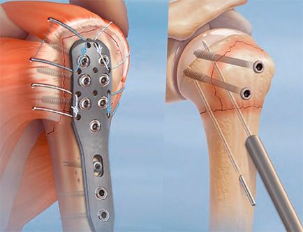 Fractura de tratament cu humerus, simptome și prim ajutor