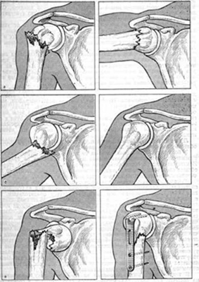 Fractura de tratament cu humerus, simptome și prim ajutor