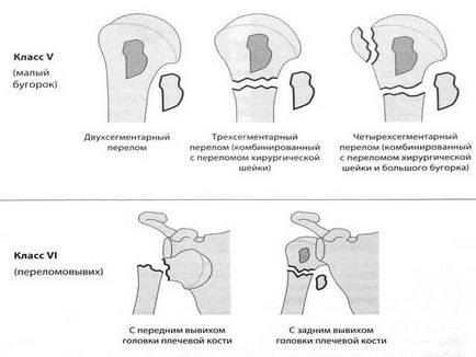 Fractura simptomelor și tratamentului umărului cervical
