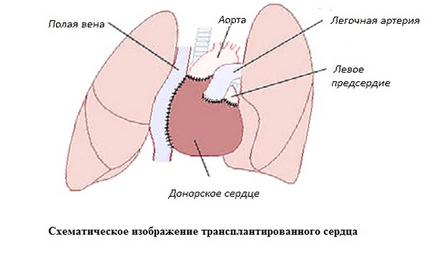 Transplantul de inimă în clinicile lumii, transplantul de inimă în Israel și Germania - medicina lumii