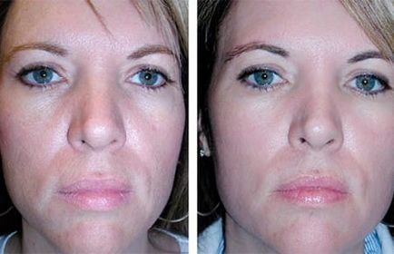 Face peeling înainte și după fotografii, recenzii