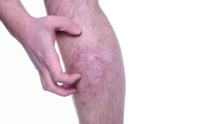 Roșeață pe picior cu tratament și prevenire a varicozei