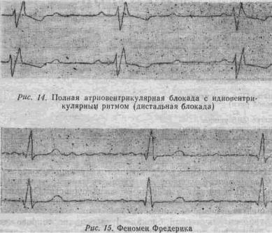 Kézi EKG (tankönyv) - dekódolása EKG