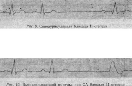 Kézi EKG (tankönyv) - dekódolása EKG