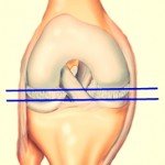 Deteriorarea ligamentului colateral tibial - simptome și mecanisme de rănire