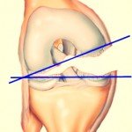 Deteriorarea ligamentului colateral tibial - simptome și mecanisme de rănire