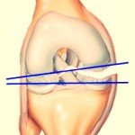 Deteriorarea ligamentului colateral tibial - simptome și mecanisme de rănire