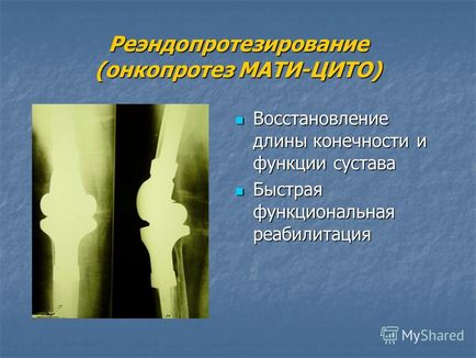 Prezentarea pe tema tratamentului ortopedic al pacienților cu hemofilie Departamentul de reconstrucție-
