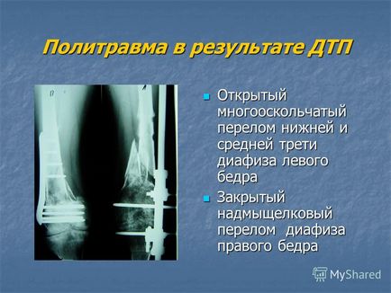 Prezentarea pe tema tratamentului ortopedic al pacienților cu hemofilie Departamentul de reconstrucție-