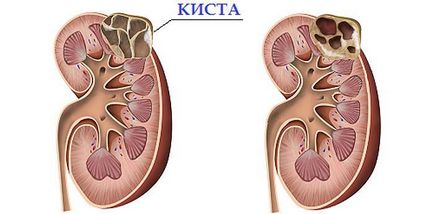 Chisturi renale simple și cauze de formare a simptomelor și tratamentului