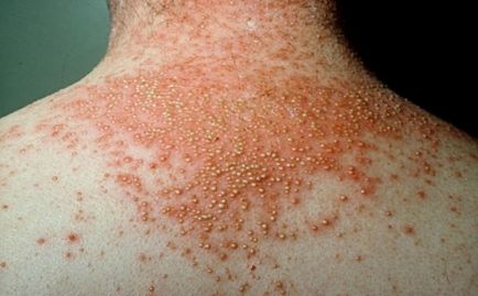 Psoriasis tünetek, kezelés