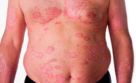 Psoriasis tünetek, kezelés