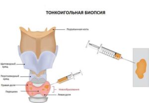 Puncția glandei tiroide și rolul acesteia în tratamentul glandei tiroide