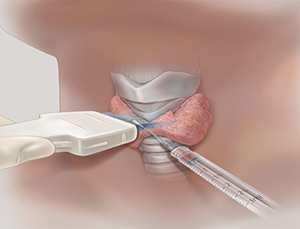Puncția glandei tiroide și rolul acesteia în tratamentul glandei tiroide