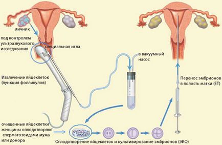 Puncția ovarului este ceea ce este ca ouă luată de la femele