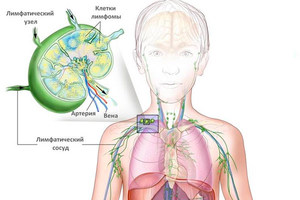 Cancerul simptomelor, cauzelor, diagnosticului și tratamentului oncologiei ganglionilor limfatici în sistemul limfatic