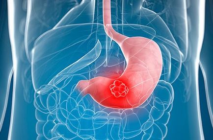 Gyomorrák mik a korai tüneteket daganatok kialakulása