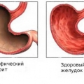 Рак шлунка - симптоми, фото, перші ознаки, дієта при раку шлунка