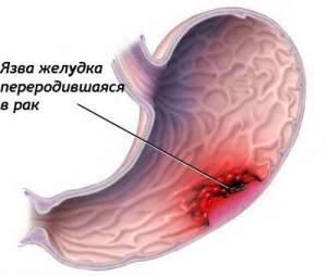 Рак шлунка - симптоми, фото, перші ознаки, дієта при раку шлунка