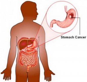 Рак шлунка - симптоми, фото, перші ознаки, дієта при раку шлунка