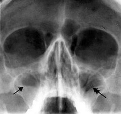 X-ray a sinusurilor nasului (radiografie a sinusurilor nazale) cât de des face, decodare