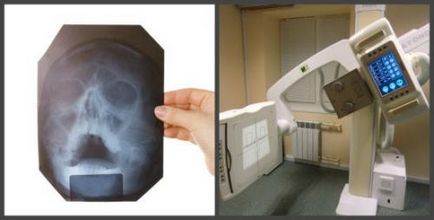 Рентген пазух носа (рентгенографія носових пазух) як часто робити, розшифровка