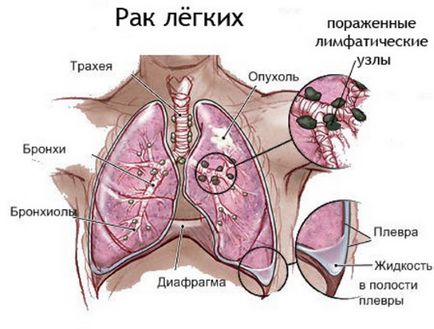 X-ray în cancer pulmonar care prezintă o radiografie
