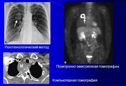 X-ray în cancer pulmonar care prezintă o radiografie