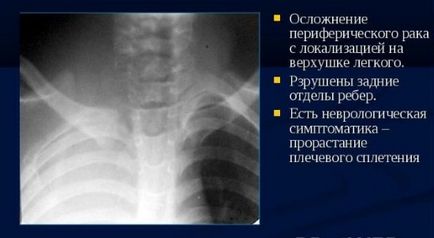 X-ray în cancer pulmonar care prezintă o radiografie