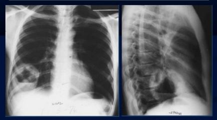 X-ray în cancer pulmonar care prezintă o radiografie