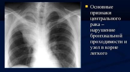 X-ray în cancer pulmonar care prezintă o radiografie