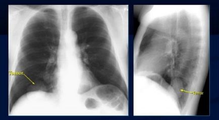 Рентген при раку легенів що показує рентгенограма