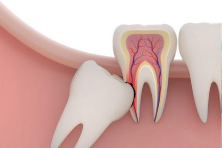 Ріжеться зуб мудрості і болить ясна - чим знеболити препарати і народні засоби