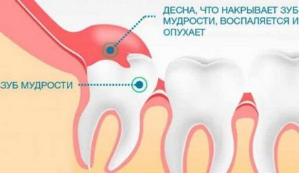 Ріжеться зуб мудрості і болить ясна - чим знеболити препарати і народні засоби