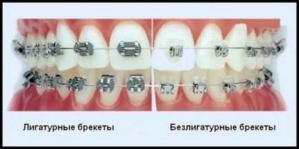 Suporturi de auto-ligare - descriere, avantaje și dezavantaje