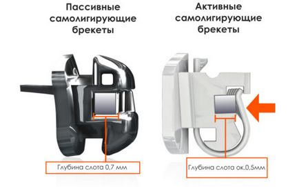 Самолігуючі брекети - опис, переваги і недоліки