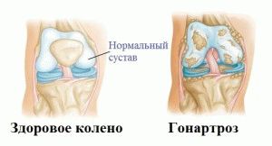 Симптоми артрозу колінного суглоба - прояви хвороби