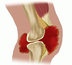 Simptomele artrozei articulației genunchiului - manifestări ale bolii