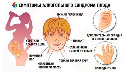 Sindromul Fas la copii și diagnosticul sindromului de alcool fetal