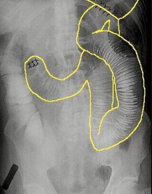 Sindromul diagnosticului și tratamentului bucla rezultată