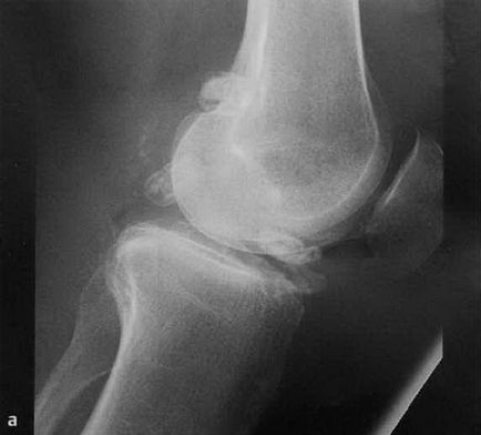 Chondromatosis synovium (szinoviális) ízületi chondromatosis