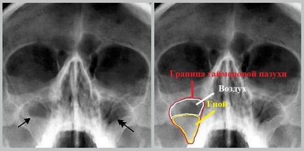 A kép egy fotó az orr, ami azt mutatja, egy X-ray a melléküregek