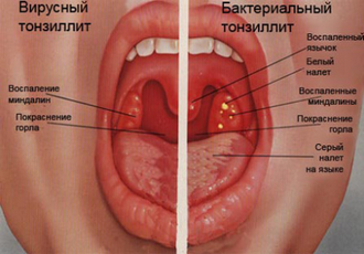 Tratamentul cu infecție cu streptococ - gtsf