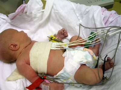 A rohamok az újszülöttek okok és a tünetek csecsemőknél