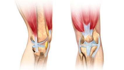 Зв'язки колінного суглоба анатомія