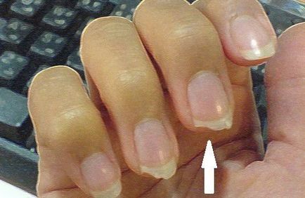 Тонкі нігті на руках причини їх ослаблення у дітей і дорослих, як лікувати, фото і відео поради